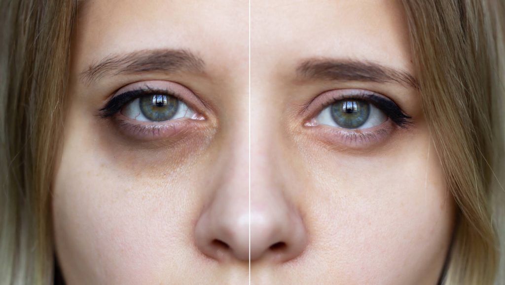 Mengenal Perbedaan antara Kantung Mata dan Dark Circles: Tips Mengatasi Masalah di Sekitar Mata - Nucell Clinic